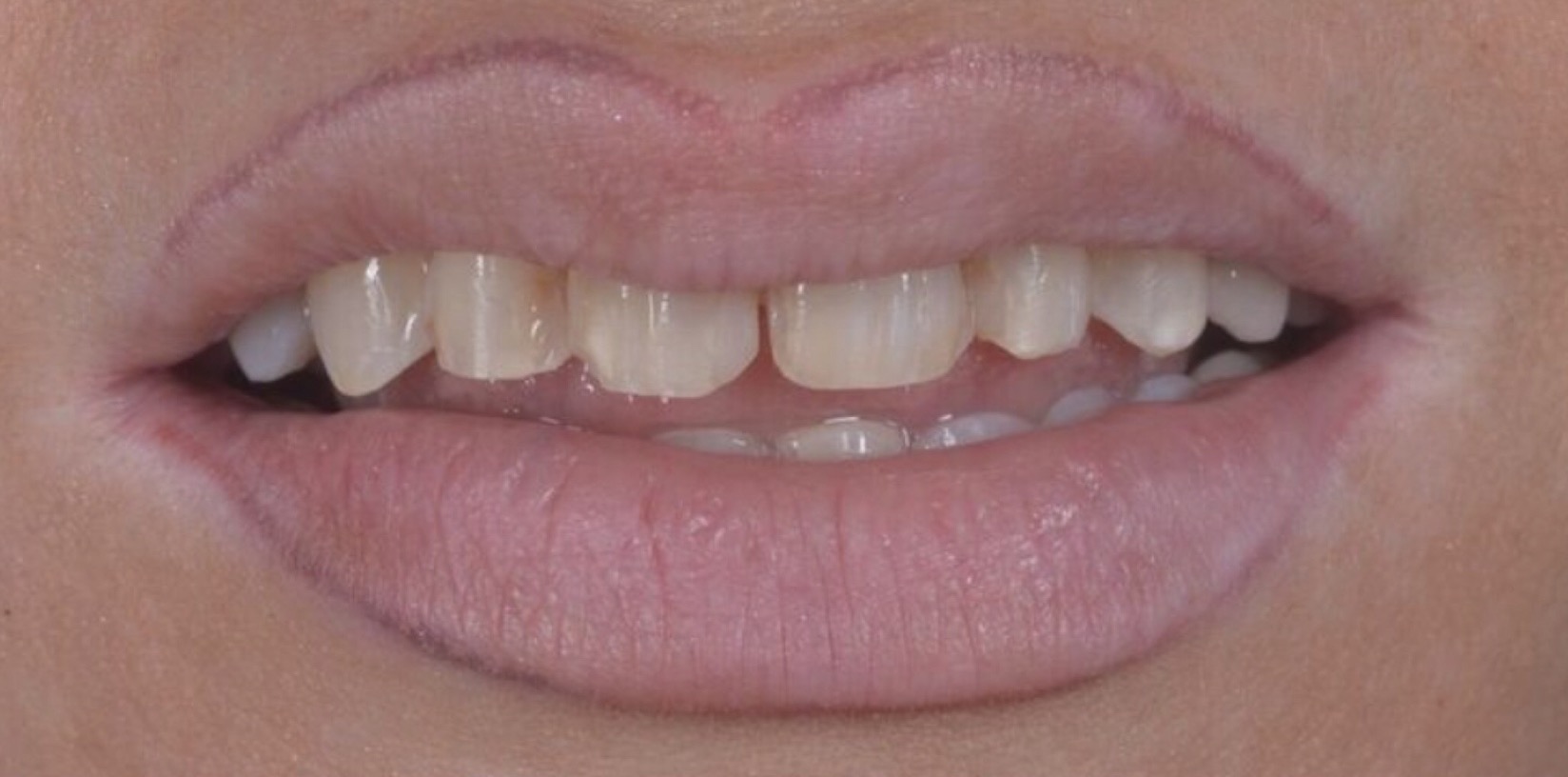 Antes