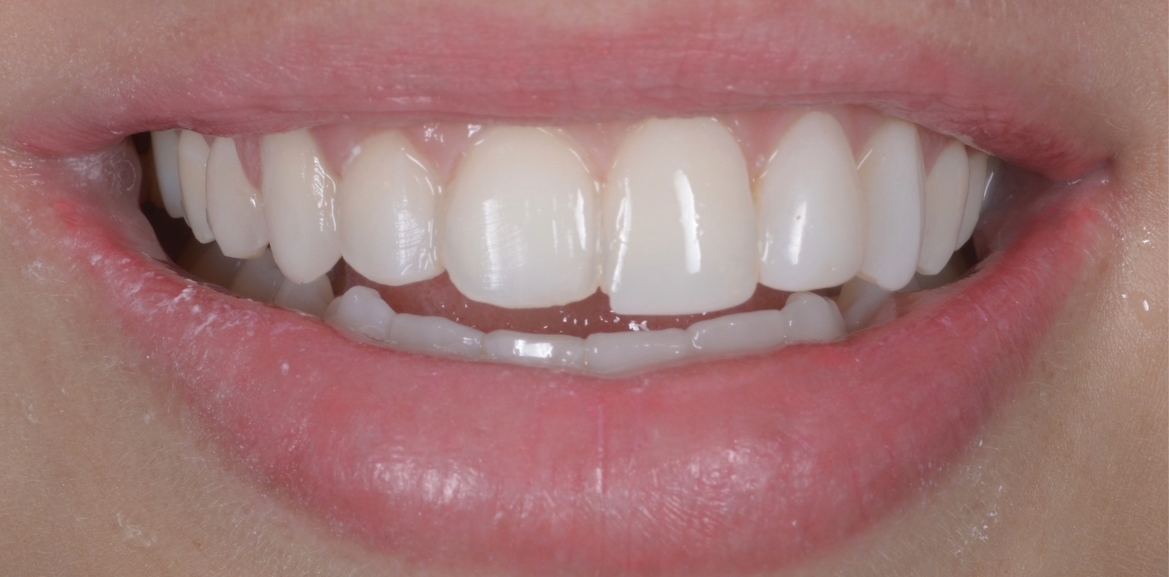 Antes